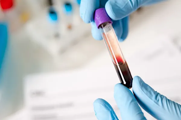 UK Study Details Liquid Biopsy's Ability to Guide Metastatic Breast Cancer Treatment