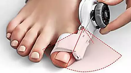 At long last, a bunion corrector that really works!