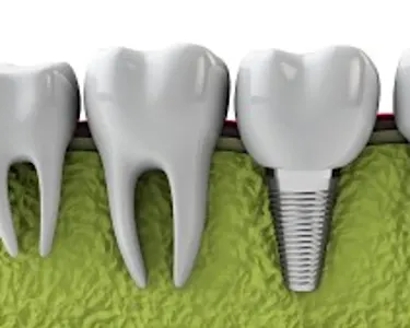El coste de los implantes dentales en Mountain View podría sorprenderte El coste de los implantes dentales en Mountain View podría sorprenderte