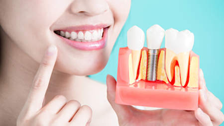 Here's How Much New Dental Implants Should Cost You