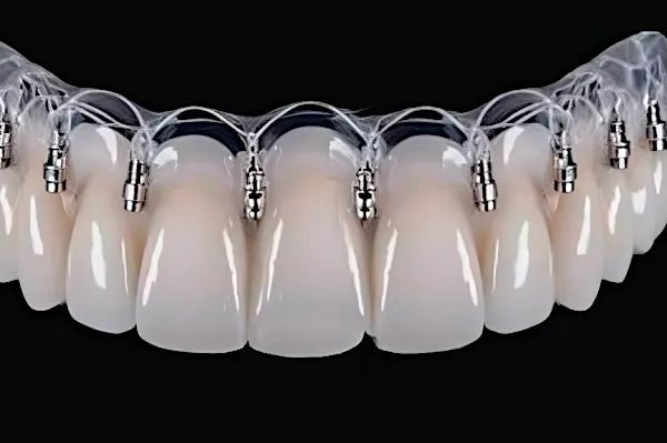 What Are Screwless Dental Implants, And How Much Do They Cost? Take a Look!