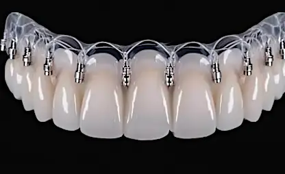 What Are Screwless Dental Implants, And How Much Do They Cost?