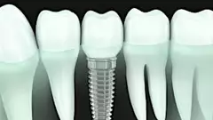 Here's What New Dental Implants Should Cost in 2020