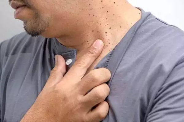 Εάν έχετε κονδυλώματα στο λαιμό ή στις μασχάλες, κάντε το αμέσως Εάν έχετε κονδυλώματα στο λαιμό ή στις μασχάλες, κάντε το αμέσως