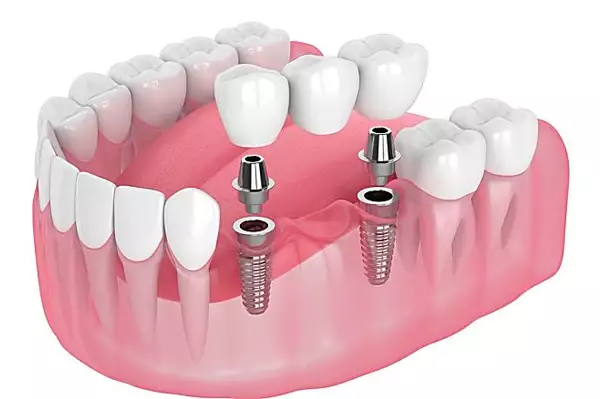 Here Is What Full Mouth Dental Implants Might Cost You In 2022