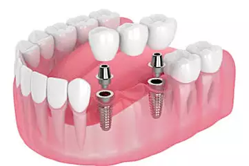 Here is what full mouth dental implants might cost you in 2021