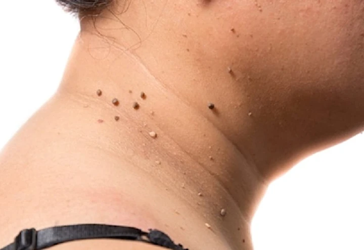 Do This Immediately If You Noticed Skin Tags or Moles (It's Genius)