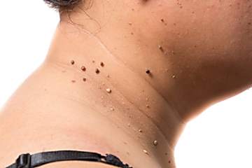 Do This Immediately If You Noticed Skin Tags or Moles (It's Genius)