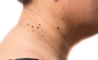 Do This Immediately If You Noticed Skin Tags or Moles (It's Genius)