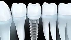 Here Is What New Dental Implants Should Cost you in 2019