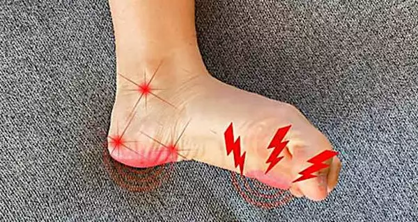 A Simple Method to Reduce Neuropathy (Watch)