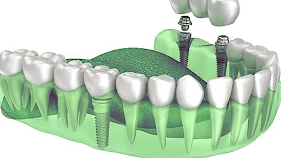 Sao Francisco De Paula: O custo dos implantes dentários pode surpreendê-lo