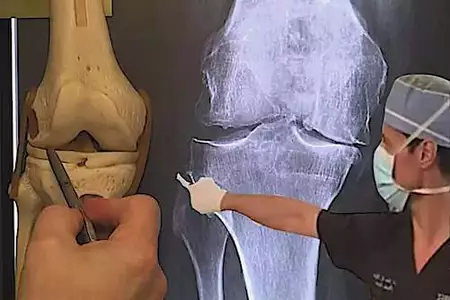 Osteoarthritis In Your Knees? This Old Trick Helps