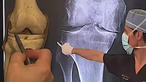 膝蓋酸痛？今晚試試這個妙招