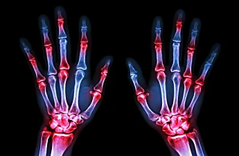 8 Signs You May Have Rheumatoid Arthritis. Research ICD 10 For Rheumatoid Arthritis