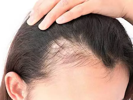 Easy Way to Regrow Hairs by Naturally Easy Way to Regrow Hairs by Naturally