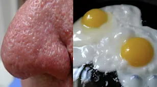 Diabetes: NHS Doctor Reveals 3 Food Mistakes that ‘Skyrocket’ Your Blood Sugar