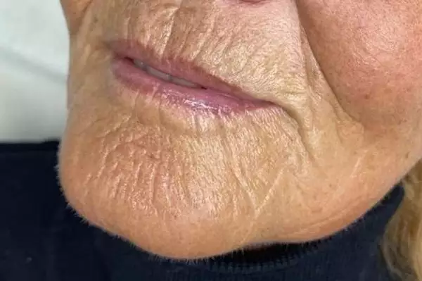 Forget Retinol, Use This Household Item To Fill In Wrinkles