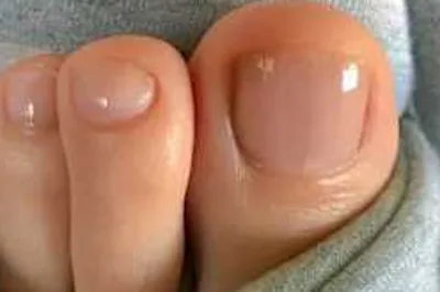 Top Podiatrist: This Mixture Can Help Burn out The Fungus After The First Use