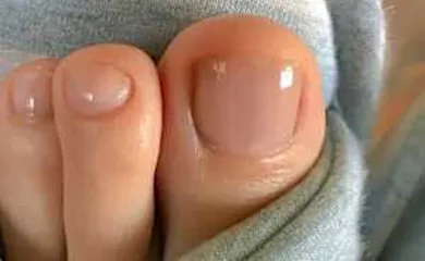 Top Podiatrist: This Mixture Can Burn out The Fungus After The First Use