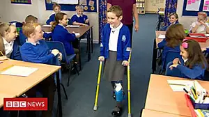 Girl walks into class on prosthetic leg