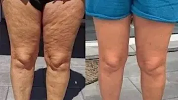 Cellulite an den Beinen weg bis zum Sommer: 1 einfacher Tipp