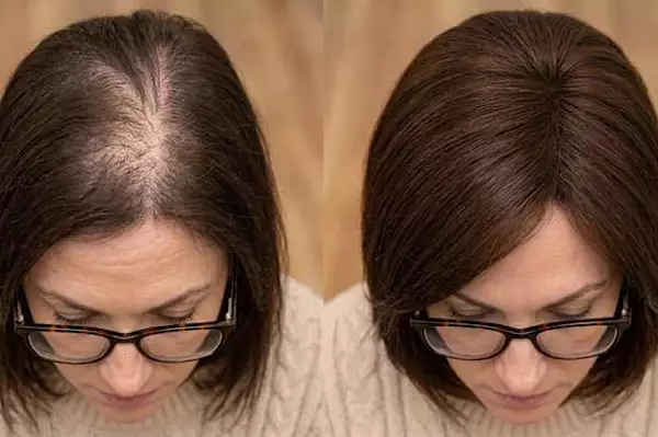 The Surprising Household Item People Are Using for Hair Regrowth The Surprising Household Item People Are Using for Hair Regrowth