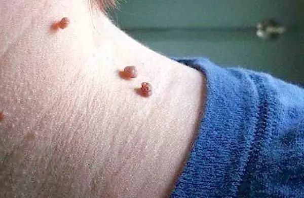Do This Immediately if You See Skin Tags or Moles