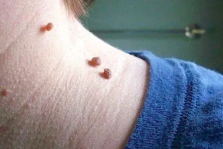 Do this
                                                immediately if you
                                                noticed skin tags or
                                                moles (It's genius)