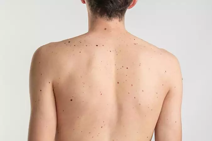 Ξέρεις ότι το μελάνωμα στο δέρμα μπορεί να θεραπευτεί; Ξέρεις ότι το μελάνωμα στο δέρμα μπορεί να θεραπευτεί;