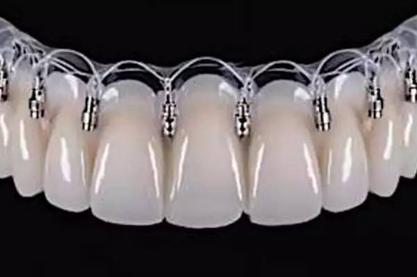 Τι καλύπτει ο ΕΟΠΥΥ για εμφυτεύματα δοντιών στην Ελλάδα