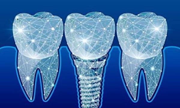 Here's What New Dental Implants Should Cost in 2020 Here's What New Dental Implants Should Cost in 2020