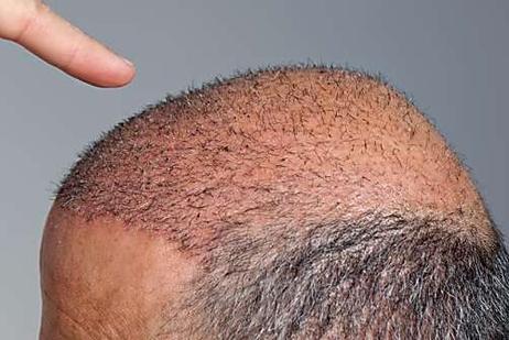 Cost of Hair Transplant in Singapore may surprise you!