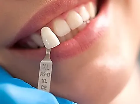 Los precios de los implantes dentales de 2022 podrían sorprenderlo