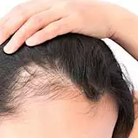 Ξέρεις πώς να σταματήσεις την αραίωση στα μαλλιά;