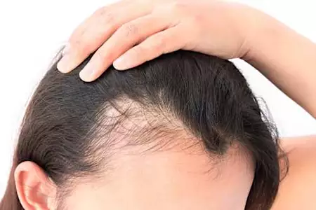 Ξέρεις πώς να σταματήσεις την αραίωση στα μαλλιά;