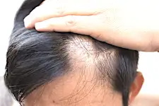 Composto premiado por desativar DNA careca chega ao Brasil