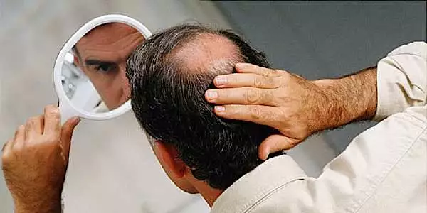 Calvície tem cura? Essa nova descoberta pode ter a resposta ideal.