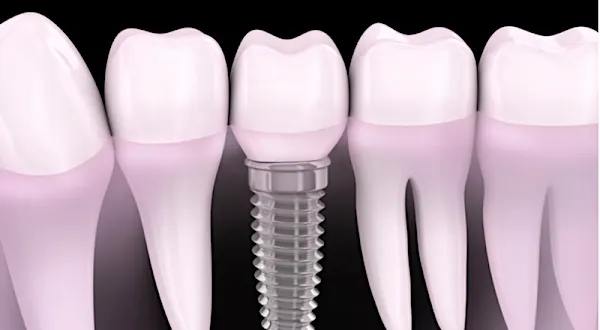Preços de implantes dentários na Chorozinho podem surpreendê-lo