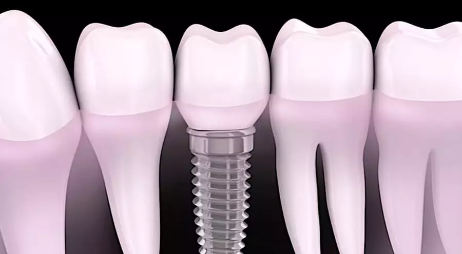Implantes dentários: lista de preços