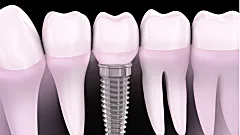 Here Is What New Dental Implants Should Cost You in 2019