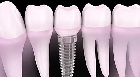 Os preços atuais para implantes-dentários podem surpreendê-lo!