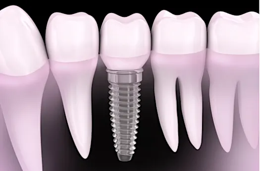 Implantes dentários: lista de preços