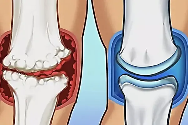 This Simple Tip Reduces Joint Pain and Arthritis (Try It Now)
