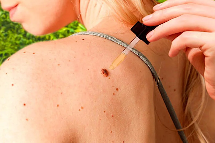 Do This Immediately If You Have Skin Tags Or Moles!