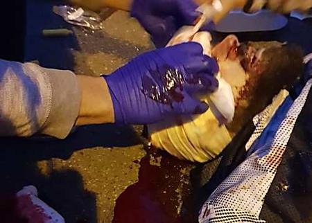 Toulouse : le manifestant gravement blessé à l'oeil, lors de la mobilisation des gilets jaunes, toujours hospitalisé