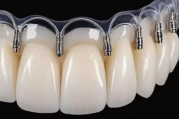 Οδοντικά εμφυτεύματα χωρίς βίδες: τι είναι και πώς λειτουργούν