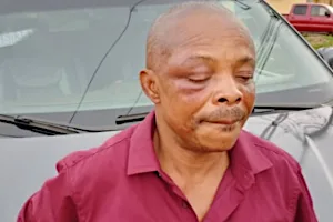 Imo protest: Ajaero in hospital, battles to save right eye Imo protest: Ajaero in hospital, battles to save right eye