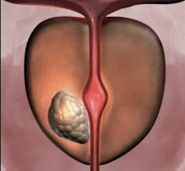 Urologist: Men With An Enlarged Prostate Do Not Know About This Simple Solution