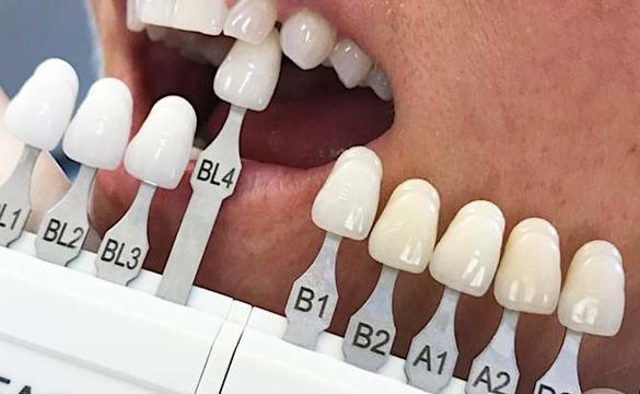 El costo de los implantes dentales en Montevideo podría sorprenderle